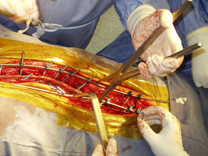 Сколиоз можно вылечить хирургическим путем