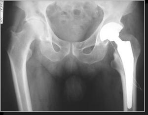 Изображение - Болезни тазобедренного сустава у женщин лечение artroz