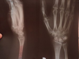 Болит кисть руки  - диагностика при помощи рентгенографии