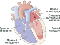 Стеноз- что это такое