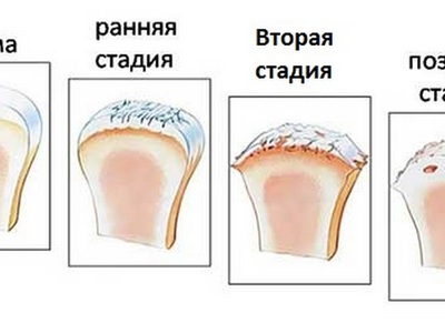 Схема лечения артроза тазобедренного сустава 2 степени