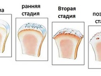 Заболевания тазобедренного сустава