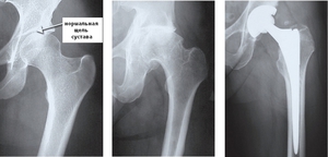 Рентгенография - здоровый тазобедренный сустав