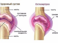 Лечение остеоартроза коленного сустава