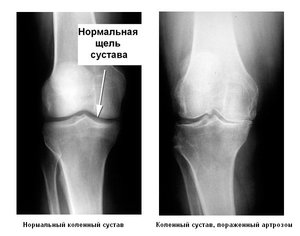 Как лечить остеоартроз коленного сустава