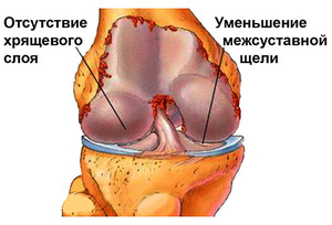 Остеорартроз коленного сустава