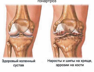 Как лечить гонартроз коленного сустава