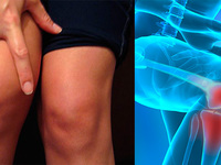 Заболевание гонартроз коленного сустава