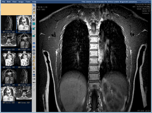 Снимок МРТ - позвоночник взрослого человека