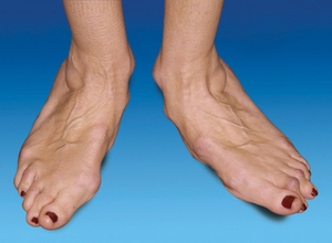 Артрит стопы - фото больной ноги