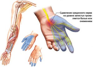 Заболевания рук