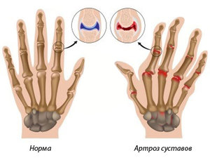 Артрит пальцев рук показан на фото