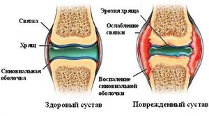 Изображение - Лекарство для восстановления хрящевой ткани суставов vosstanovlenie-hryaschei