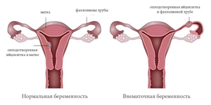 Внематочная беременность - наглядная схема