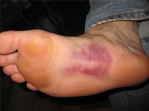 Травма стопы могут быть причиной болезненных ощущений