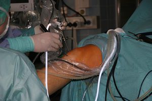Описание процедуры операции на коленный сустав