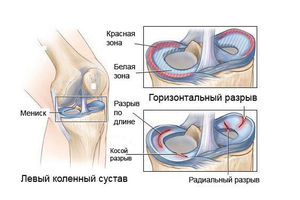 Как лечить разрыв мениска коленного сустава