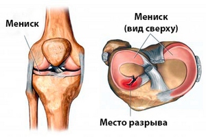 Как лечат мениск коленного сустава