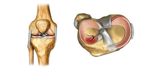 Виды повреждения коленного сустава