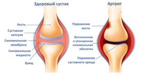 Артрит коленного сустава - причины появления