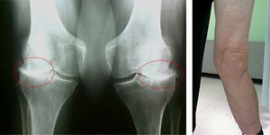 Гонартроз коленного сустава - рентгеновский снимок