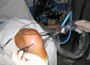 Артроскопия коленного сустава - особенности операции