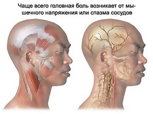 Цефалгия головного мозга - признаки болезни